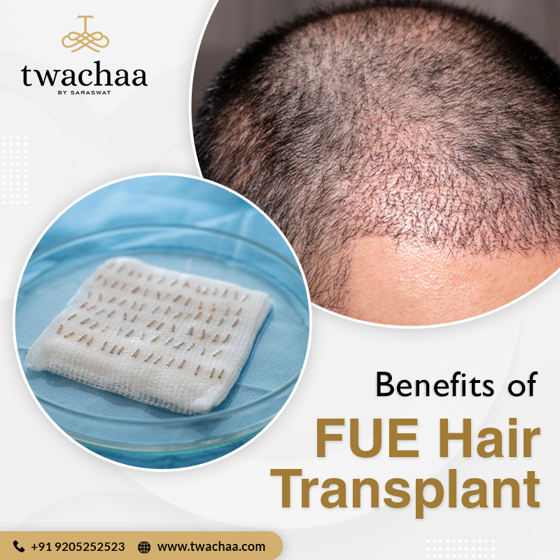 What Are The Benefits Of Opting For Fue Hair Transplant In Faridabad