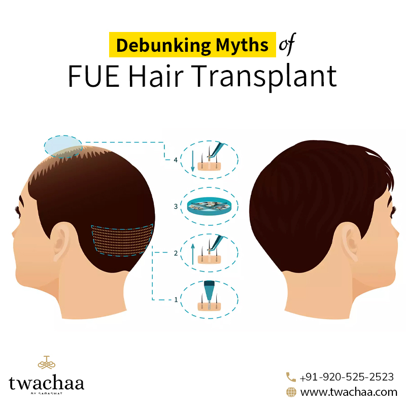 Debunking Myths Associated with FUE Hair Transplant India