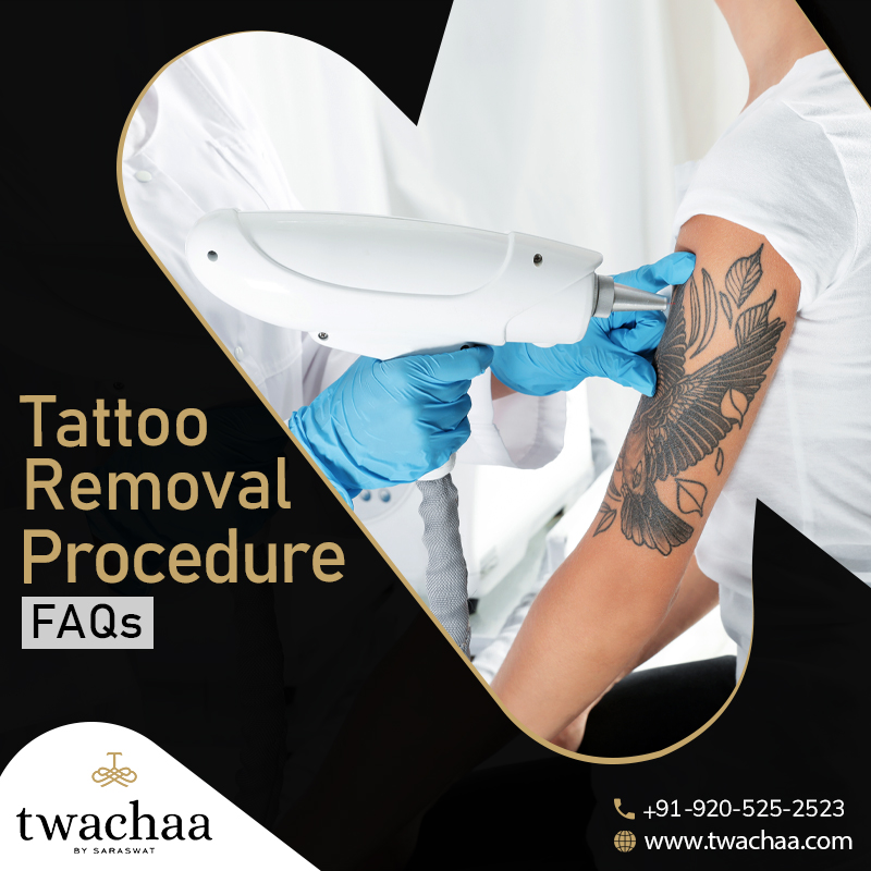 Frequently Asked Questions about the Best Tattoo Removal Procedure