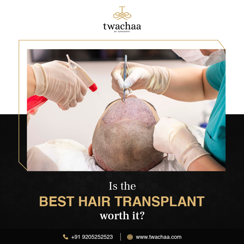 Is the Best Hair Transplant in Faridabad Worth It