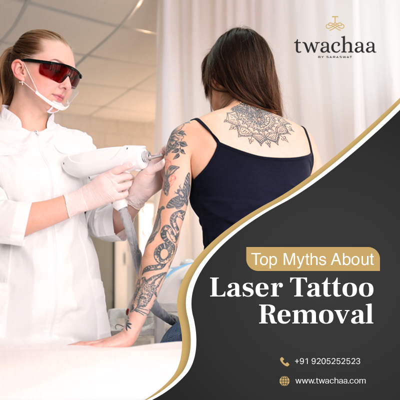 Myths about Laser Tattoo Removal