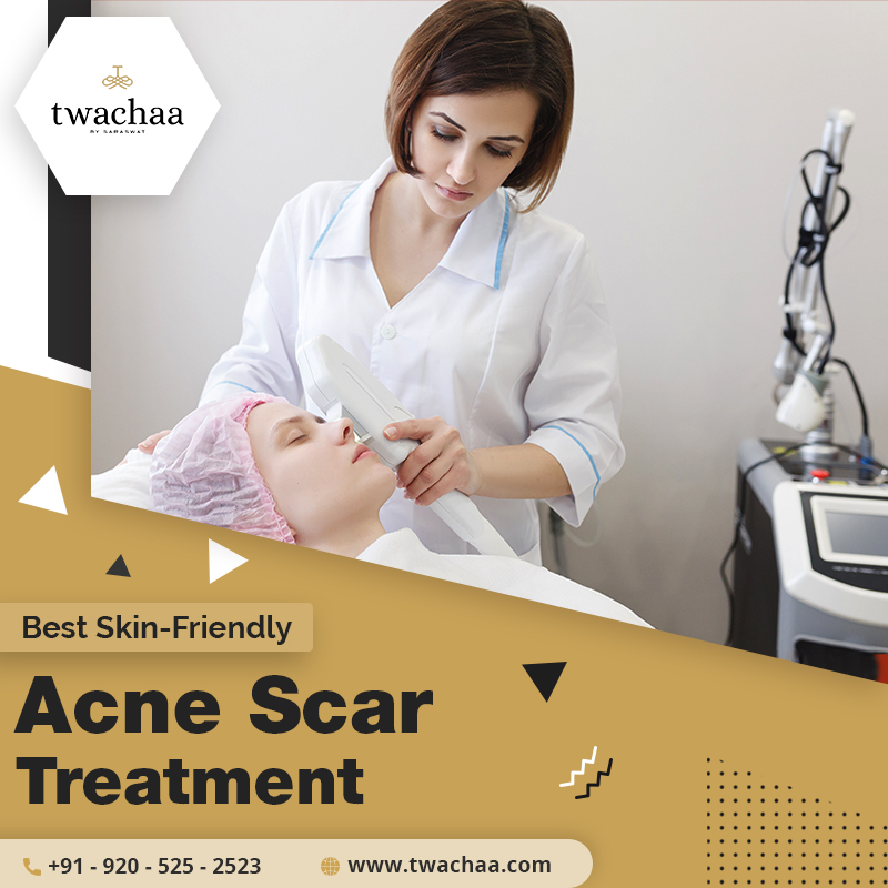 best acne scar treatment