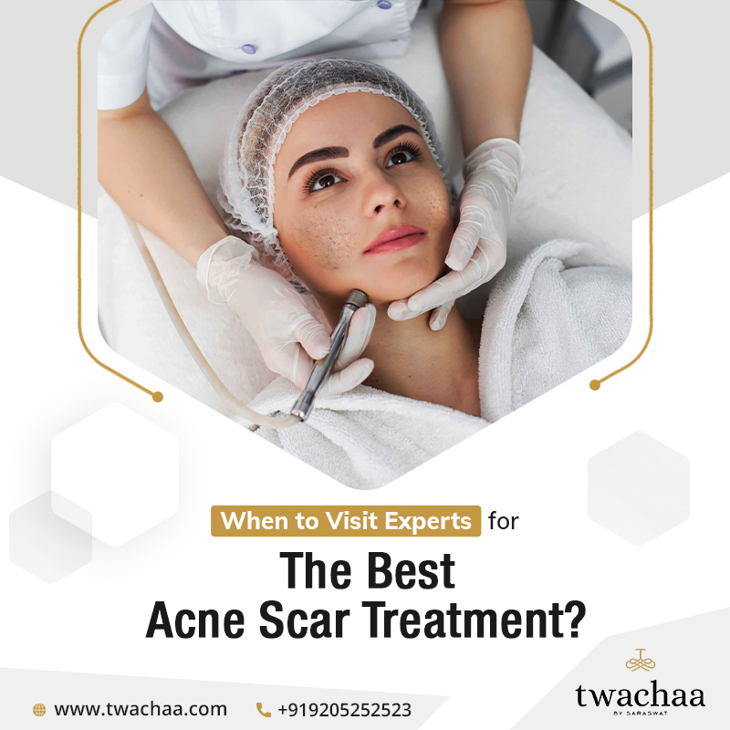 Visit Experts for the Best Acne Scar Treatment