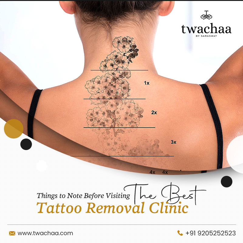 Where to get the best tattoo removal in Jaipur