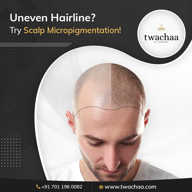How can Scalp Micropigmentation Help with an Uneven Hairline