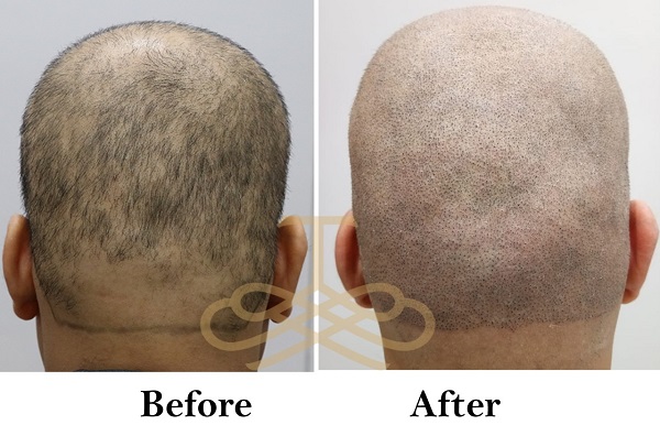 Scalp Micropigmentation Results