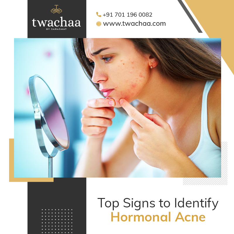 Top Signs that you are suffering from Hormonal Acne