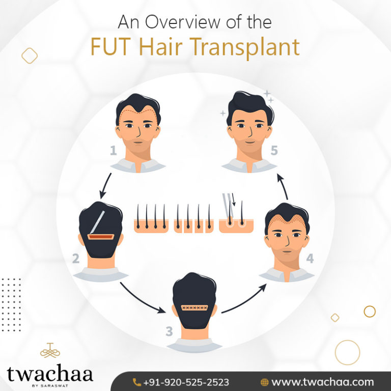 The Complete Guide to FUT Hair Transplant Surgery