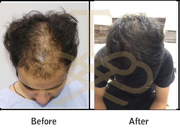 Hair Transplant Surgery Result