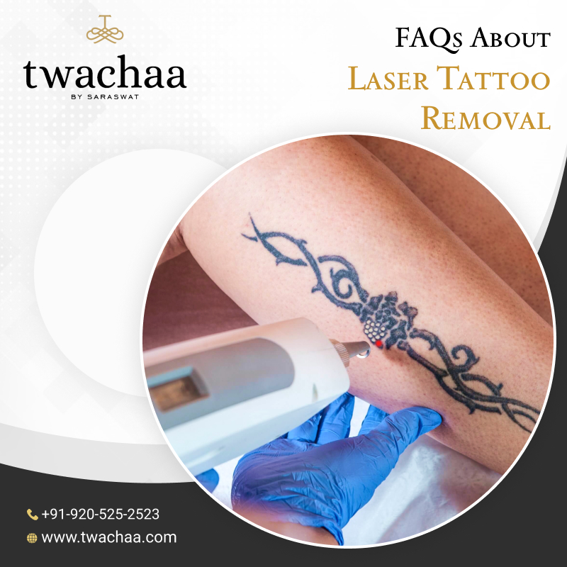 FAQs About Laser Tattoo Removal