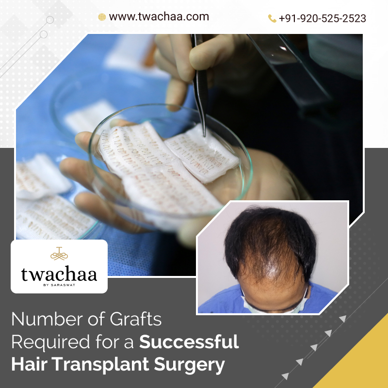 Grafts are Required for the Best Hair Transplant Procedure