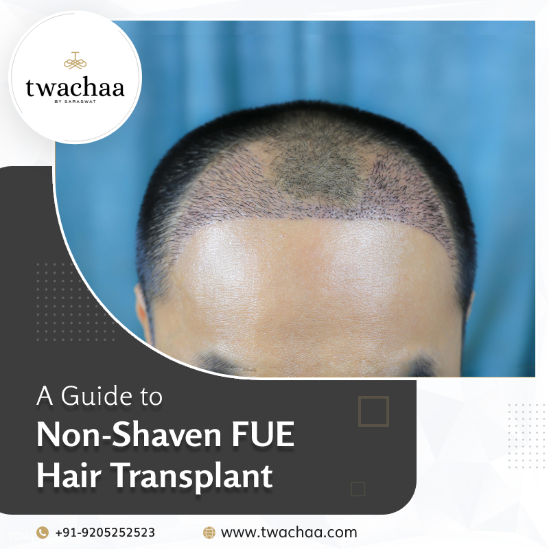 Non-Shaven FUE Hair Transplant