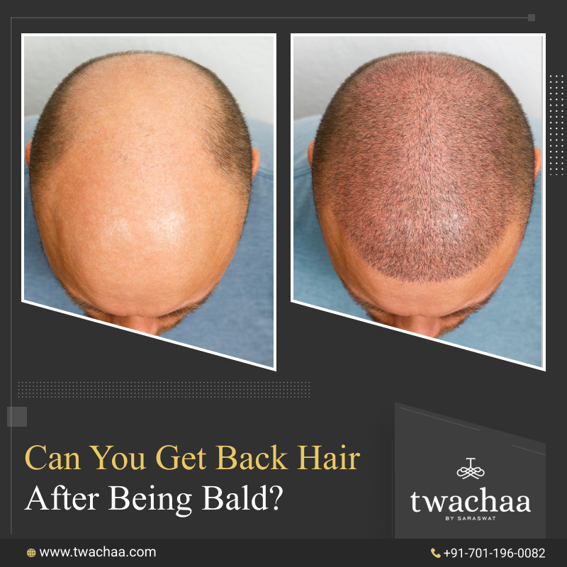 Can You Get Back Hair after Being Bald?