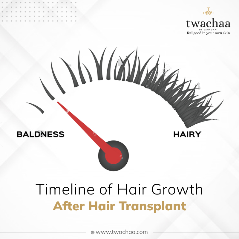 hair transplant timeline