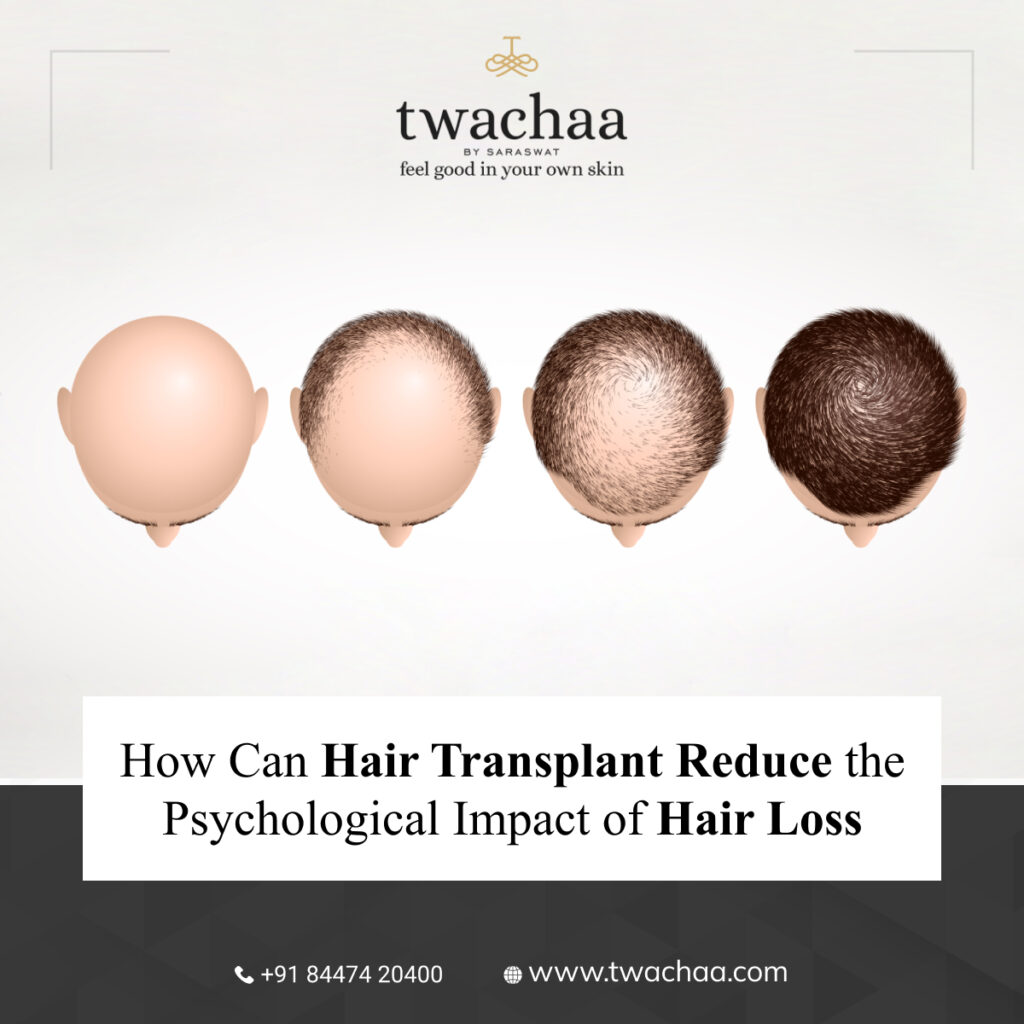 The Psychological Impact of Hair Loss and How Hair Transplant Can Help