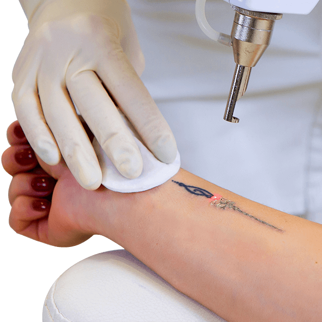 How To Remove A Tattoo Naturally | Tattoo Removal Institute