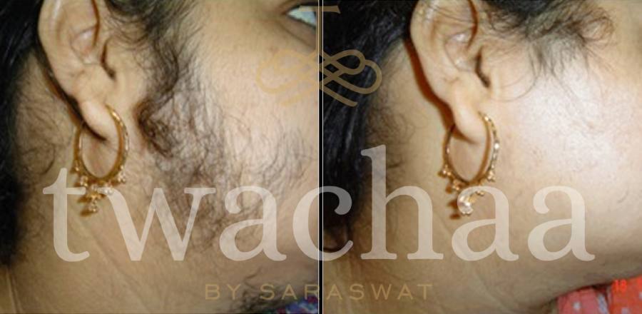 Laser Hair Removal in Faridabad Twachaa by Saraswat